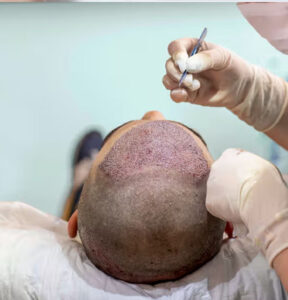 Hair Transplantation