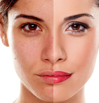 Pigmentation Treatment