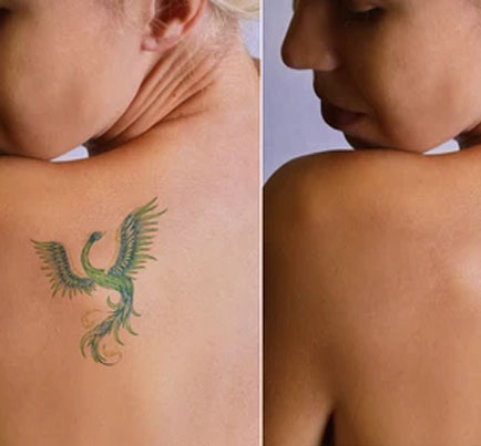 Tattoo Removal