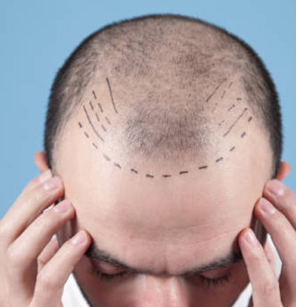 hair transplantation