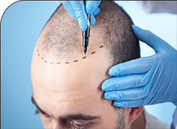 Hair Transplantation