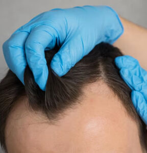 scalp micropigmentation2