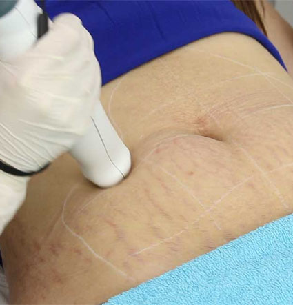 stretch marks removal